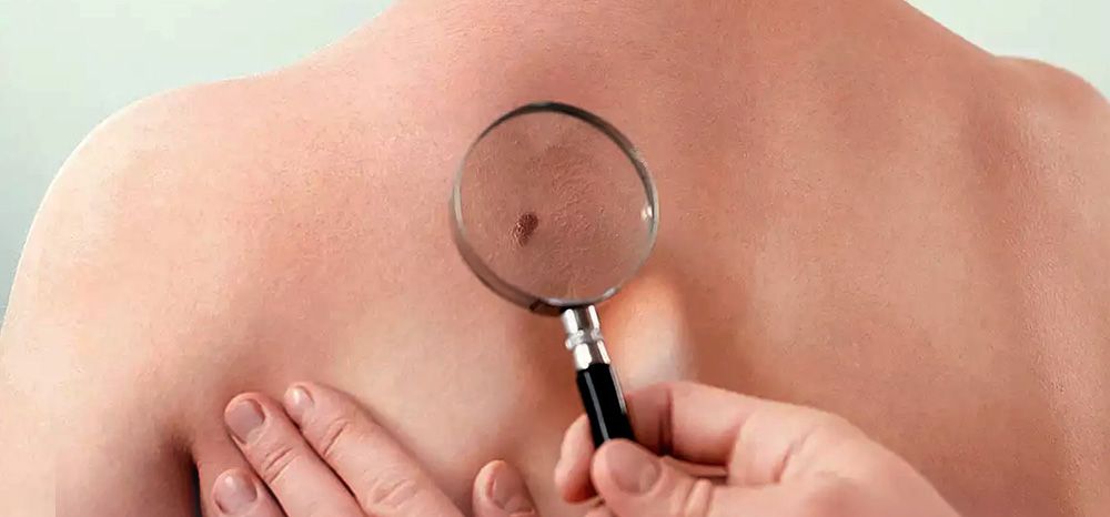 Como identificar o câncer de pele